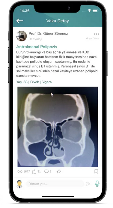 Prof. Dr. Güner Sönmez'in Medklik'te Antrokoanal Polipozis başlıklı vaka paylaşımı
